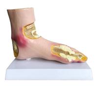 Gout Foot Model, Life-Size Left Foot with Joint Tophi for Medical Teaching, Includes Stand and Description Card