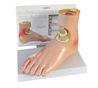Gout Foot Model, Pathological Left Foot with Joint Litholysis - Medical Education Display Base & English Back Card