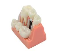 GTHTUHFD Research On Flexible Teeth Models For Dental Implants Scientific Teaching Dental Implant Model Analysis Bridge Teeth Demonstration