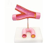 HADECOLL Educational Model Medical Anatomical Human Blood Vessel Model -Arteriosclerosis Model With Thrombus Coronary Heart Disease Vascular Anatomical Model Medical Teaching