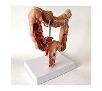 HADECOLL Human Large Intestine Anatomical Model Colon Pathology Model Lesion Model Human Anatomical Anatomy Teaching Model