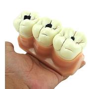 HADECOLL Human Teeth Anatomical Model Pathological Caries Decomposition Demonstration Model For Dentist Studying Researching And Patient Education