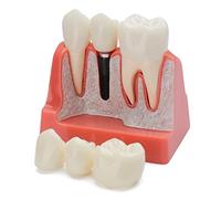 Healthible Dental Implant Model - Implant Vs Bridge Dental Model 4 Times Removable Analysis Crown Bridge Demonstration Teeth Model