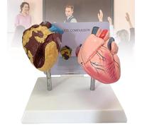 Heart Anatomy Model, Smoking Heart and Normal Heart Comparison Model, Suitable for Learning, Display & Teaching Medicine