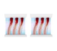 Hfgdnchva 2X Dynamic Blood Vessel Model Cardiovascular Blockage Contrast Model Thrombosis Model for Teaching Explanation