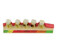 HiyyFloy Teeth Periodontal Disease Model Dental Caries Breakdown Display Model Teaching Tooth Model Perio Disease Assort Demo