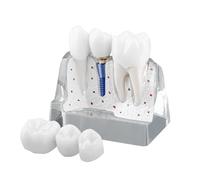 Hoite Dental Implant Model Clear with Resin Crowns Metal Implants Abutments Separable Parts 4X Magnets Secure Bridge