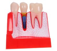 Holibanna Enlarged Teeth Teaching Model Realistic Model for Student Practice Classroom Demonstration Portable Learning Aid for Enhanced Understanding of Tooth Structure