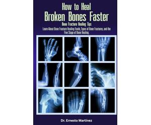 How to Heal Broken Bones Faster. Bone Fracture Healing Tips: Learn About Bone Fracture Healing Foods, Types of Bone Fractures, and the Five Stages of Bone Healing: 5 (Health and Wellness)