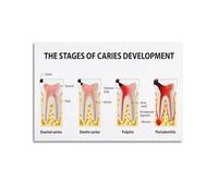 HSMXNEONJB Dental Pathology Educational Chart - Progression of Tooth Decay Stages Poster, Oral Health Care Wall Art for Office & Home(Unframed,16x24inch(40x60cm))