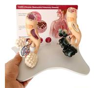 Human Alveolar Anatomical Model, Comparative Display of Smoking vs Healthy Alveoli, Enlarged Structure for Enhanced Health Education