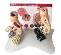 Human Alveolar Anatomical Model for School Teaching, Smoking vs Healthy Alveoli Comparison, Enlarged Structure with English Back Card, Educational Display
