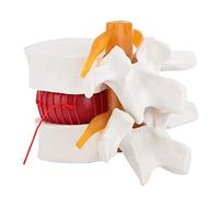 Human Anatomical Lumbar Disc Herniation Model, 1.5 Times Life Size Lumbar Vertebrae Disc Herniation Model for Teaching, Learning and Demonstrating