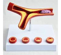 Human Anatomical Model Human BloodModelarteriosclerosis Model with Thrombus Coronary Heart Diseasevascular Anatomical M