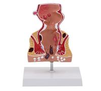 Human Anatomical Model Rectum Pathologies of Teaching Aid for Science Education for Anatomy Pathologies of Teaching Aid