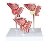 Human Anatomical Prostate Model -1: 1 Life-Size Prostate Model PVC Material Normal and Injured Representation Human Anatomy Science Models