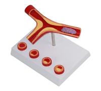 Human Anatomy Blood Vessel Models, Atherosclerosis Model, Atherosclerosis Cardiovascular Medical Model, Blood Vessel Anatomical Model Suit For Medical Classroom Teaching Study
