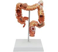 Human Anatomy Colonic Lesion Model for Gastroenterology Education, Medical Study Model for Understanding Anorectal Functions and Pathologies