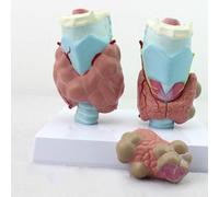 Human Anatomy Model Enlarged Thyroid Pathology Model Hyperthyroidism Model Human Thyroid Anatomy Model Set with Stand Base for Medical Teaching