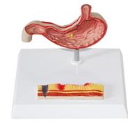 Human Anatomy Stomach, Stomach Perforated Stomach Pathology Model, Stomach Pathology Gastritis Ulcer Medicine Teaching Learning Tool