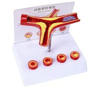 Human Artery Atherosclerosis and Thrombosis Model with Instruction Card