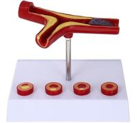 Human Blood Vessel Anatomical Model, Cardiovascular Arteriosclerosis Model, Atherosclerosis Model, Human Thrombosis Model for Medical Teaching Display.