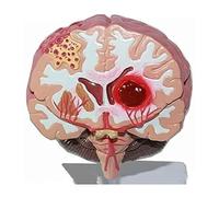 Human Brain Anatomical Model, Cerebral Hemorrhage Cerebral arteriovenous Malformation Pathological Model, Brain Anatomical Model for Medical Teaching Science Classroom Learning