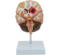 Human Brain Anatomical Model for Medical Education, Pathology Study Display, Cerebral Hemorrhage & Stroke Teaching Tool for Science Classroom