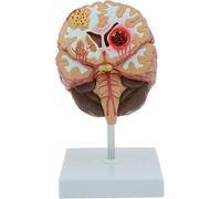 Human Brain Stroke Model,Cerebral Hemorrhage Cerebral Arteriovenous Malformation Pathological Model, Life-Size Human Brain Structure, for Doctor Education and Training Display.