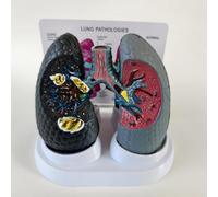 Human Bronchopulmonary Anatomy Model, Smoking vs Healthy Lung Comparison, for Medical Education and Lectures