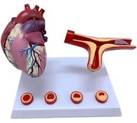Human Cardiac Pathology Model, Heart Coronary Artery Bypass Model, Blood Vessel Blockage Thrombosis Model, for Medical Teaching Doctor Patient Communication.