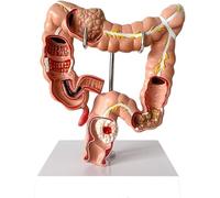 Human Colon Anatomical Model, Colon Pathology Model, 1/2 Life Size Digestive System Colon Lesion Anatomical Teaching Tool, for Medical Education