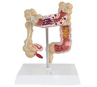 Human Colon Disease Model Large Intestine Pathology Model Rectal Appendix Model Anorectal Doctor patient Communication Model Teaching Demonstration