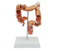 Human Colon Lesion Anatomical Model with Base Detailed Gastroenterology Pathology Large Intestine for Medical Teaching Human Torso Model