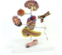 Human Diabetes Organ Anatomy Model - 8 Pieces Pathological Complications for Doctor-Patient Communication