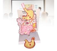 Human Digestive System Anatomy Model - Large Intestine, Rectum, Duodenum, Cecum, Stomach Ulcer - Pathological Teaching Tool for Learning and Education