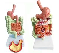 Human Gastrointestinal Anatomy Model, Digestive System Model with Colon Disease Representation