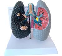 Human Health and Smoking Lung Comparison Model, Human Bronchopulmonary Model, with English Back Card, Lung Anatomy Display, for Emonstrate The Effects of Smoking on Lung Health