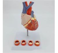 Human Heart Anatomical Model with Thrombus Enlarged Model of The Heart 1:1 Life-Size Detachable Human Heart Anatomical Model Teaching Tool