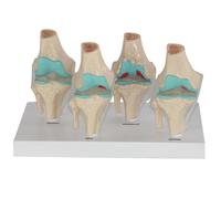 Human Knee Joint Model Human Body Anatomy Replica Set of 4-Stage Osteoarthritis Knee Joint for Doctors Office Educational Tool Clinic Demonstration Learning Education Display Tool