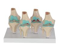 Human Knee Joint Model, Human Body Anatomy Replica Set of 4-Stage Osteoarthritis Knee Joint for Doctors Office Educatio