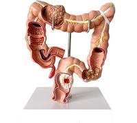 Human Large Intestine Anatomical Model, Visceral Lesion Colon Pathology Model, Digestive System Studying Teaching Models, for Medical Education Display.