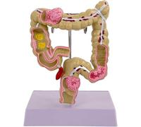 Human Large Intestine Model, Colon Pathology Anatomical Model, Colorectal Lesions Intestinal, Digestive System Studying Teaching Models, for Medical Education Display.