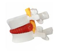 Human Lumbar Disc Herniation Model 1.5 Times Life Size Human Lumbar Herniated Disc Demonstration Anatomy Model, Lumbar Spine Model for Teaching Learning