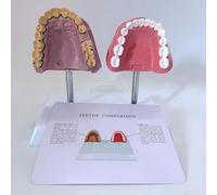 Human Oral System Teeth Anatomy Model, Smoking Teeth and Healthy Teeth Comparative Model with Accurate Anatomy Structure and Pathological Features for Dental Students, Clean Display