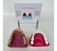 Human Oral System Teeth Anatomy Model, Smoking Teeth and Healthy Teeth Comparative Model, with Accurate Anatomy Structure and Pathological Features, for Dental Students
