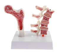 Human Osteoporosis Anatomical Model with Base, Spine Model for Classroom Demonstration, Visualizing Pathological Changes in Femoral Anatomy