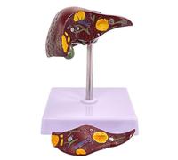 Human Pathological Liver Model, Highly Realistic pathological Liver Anatomy Model with Clear Texture and pathological Features and 2 Detachable Parts for Educat