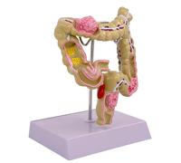 Human Pathologies of Large Intestine Model Anatomical Medicals Teaching Aid Human Pathologies of Teaching Tool