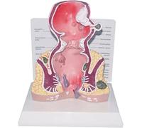 Human Pathologies of Rectum Anatomical Model, Hemorrhoid Pathological Diseases Intestine Medical, Human Anatomical Model, for Doctors Office Teaching Educational Tool
